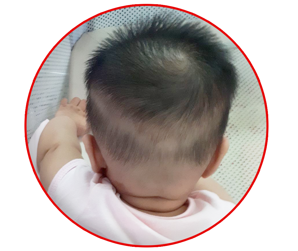 rụng tóc vành khăn