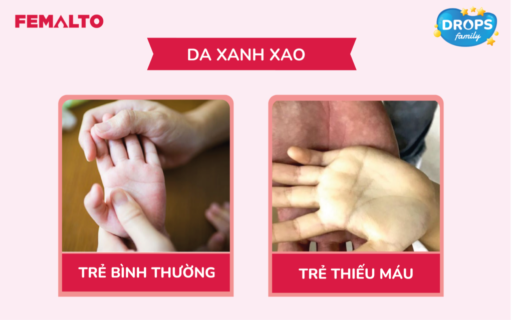 thiếu máu ở trẻ em